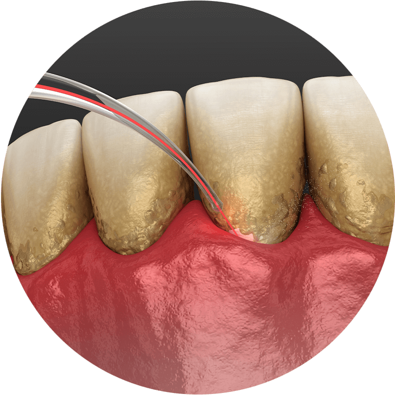 Dental Laser